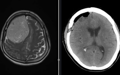 Đau đầu, yếu nửa người, khám bệnh phát hiện khối u màng não nặng 600 gram