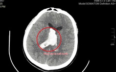Cứu sống một thầy giáo trẻ bị đột quỵ nguy kịch