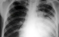 Cảnh báo về vi khuẩn trong hơi thở dễ làm lây lan bệnh hô hấp