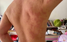 Bác sĩ 24/7: Nổi mề đay ngứa ngáy khó chịu, có cần xét nghiệm tìm nguyên nhân?