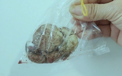 Cô gái về từ khu 'Tam Thái Tử' ở Campuchia, nguy kịch vì sỏi bàng quang