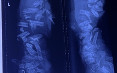 Ca tai nạn lao động thương tâm: Cánh tay bị máy nghiền vỏ dừa cán nát