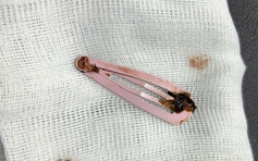 Nuốt kẹp tóc dài 7 cm trong lúc ngủ trưa, bé gái 6 tuổi phải nhập viện