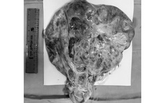 Mổ nội soi lấy khối u nặng hơn 6 kg cho nữ bệnh nhân ở Vĩnh Long