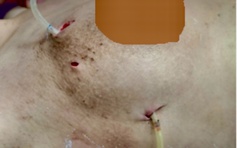 Ngực biến dạng do tiêm filler làm đẹp