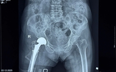 Thay khớp háng thành công cho cụ bà 100 tuổi