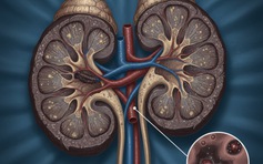 Suy thận tăng vào mùa đông: Bác sĩ chỉ cách phòng bệnh