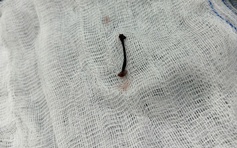 Tắm suối, bé trai 30 tháng tuổi bị vắt chui vào mũi