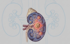 Sỏi thận tái phát: Nguyên nhân và cách giảm nguy cơ