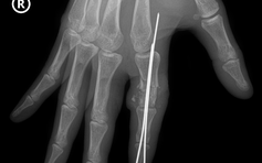 Cứu sống ngón tay thủy thủ bị đứt rời sau 25 giờ