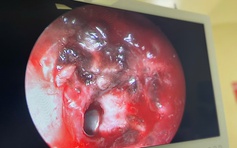 Đang chơi súng đồ chơi, bé trai bị viên bi bắn xuyên má trái