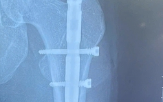 Nữ người mẫu cao 1 mét 78 gãy chân khi thi đấu pickleball ở TP.HCM