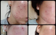 Top 12 kem trị mụn hiệu quả, không để lại thâm