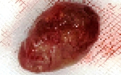 Phẫu thuật cắt bỏ thành công khối u trong tuyến mang tai hiếm gặp