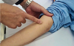 Viêm não mô cầu: Dấu hiệu cảnh báo cần cấp cứu ngay