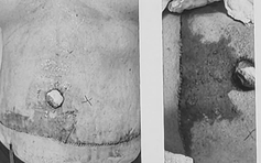 Báo động đỏ tai biến hút mỡ bụng tại TP.HCM