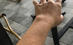 Cẩn trọng trào lưu trên mạng xã hội: Ngứa sau thời gian uống nước chanh, do đâu?