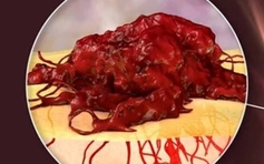 Mắc ung thư bị chẩn đoán sai, phải cắt một phần dương vật