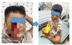 Đang chơi đùa, bé trai 5 tuổi bị chó cắn rách mặt
