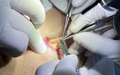 Cắt mí mắt là gì?