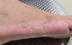 Ngứa dai dẳng do giun móc chó mèo