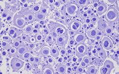 Nghiên cứu: Tìm ra cách điều trị hiệu quả ung thư gan, phổi và dạ dày