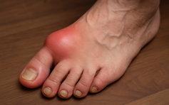 Bệnh gout ngày càng ‘trẻ hóa’ và nguy cơ tổn thương thận