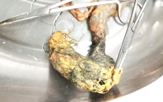 Hy hữu: Búi tóc dài 12 cm trong ruột bé gái 4 tuổi