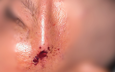 Người đàn ông nhập viện với nhánh cây đâm xuyên dưới da