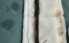 Bé gái 3 tuổi mang cành cây dài 16 cm trong bụng suốt 4 tháng