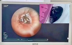 Ho dai dẳng 10 năm vì hạt sapôchê kẹt trong phế quản