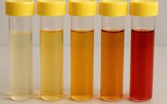 Màu nước tiểu cảnh báo thận đang gặp vấn đề