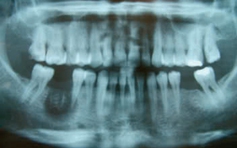 Sử dụng thạch tín trong điều trị nội nha gây nguy cơ gì?