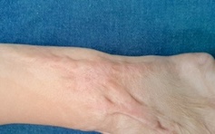 Trẻ 4 tuổi bị bỏng nặng do ngã vào nồi nước sôi