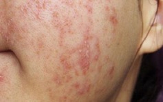 Bác sĩ cảnh báo về trào lưu 'đào thải corticoid' trên mạng