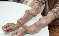 Điều trị ca bệnh thận nhân tạo biến dạng tay do giãn tĩnh mạch