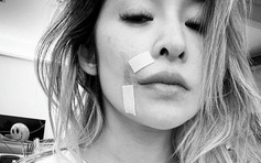 Diva Đài Loan Tiêu Á Hiên biến dạng gương mặt sau khi bị chó tấn công