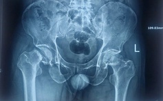 Phát hiện bị hoại tử xương sau nhiều năm chịu đựng cơn đau khớp háng