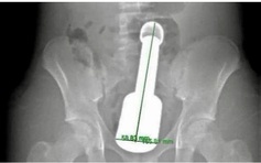 Chày kim loại kẹt trong trực tràng: Tuổi dậy thì và tâm lý 'một mình, thử xem sao'