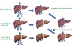 Lần đầu tiên Việt Nam ghép đa tạng domino