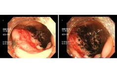 Đau bụng tưởng bình thường, nhiều người trẻ mắc ung thư đại trực tràng giai đoạn muộn