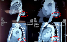 Việt Nam lần đầu dùng robot mổ điều trị phổi biệt lập thành công