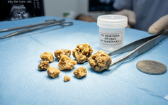 Sỏi thận có thể tự đào thải được không?