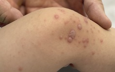 Việt Nam chờ vắc xin tay chân miệng nhập về hạ nhiệt dịch