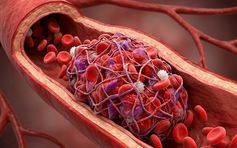 Vì sao tiểu đường lại dễ gây đột quỵ?