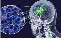 Cà Mau: 3 ca nghi viêm não mô cầu, 2 ca dương tính, 1 ca tử vong