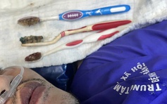 Nuốt 3 bàn chải đánh răng dài 20 cm, nam thanh niên nhập viện nguy kịch