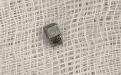 Bé trai 5 tuổi ho, đau họng, đi khám phát hiện nuốt 7 viên nam châm