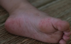 Bệnh tay chân miệng và sốt xuất huyết gia tăng mạnh tại Cần Thơ