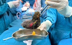 Búi tóc 'lấp kín' dạ dày bé gái 7 tuổi, cảnh báo hội chứng nguy hiểm